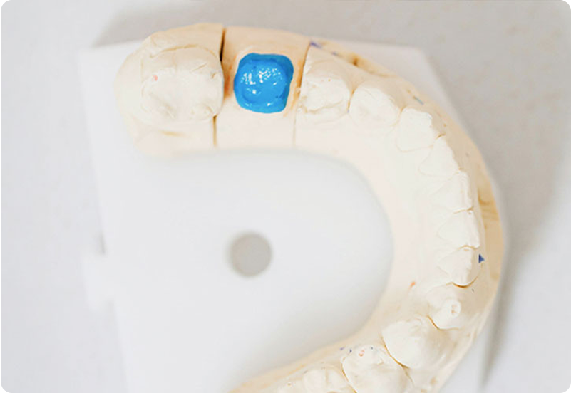 Dental Crowns in Spain hero image